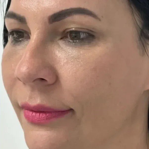luciana-tchaick-harmonizacao-orofacial-caxias-do-sul-antes-e-depois (1)