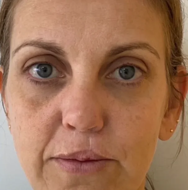 luciana-tchaick-harmonizacao-orofacial-caxias-do-sul-antes-e-depois (3)