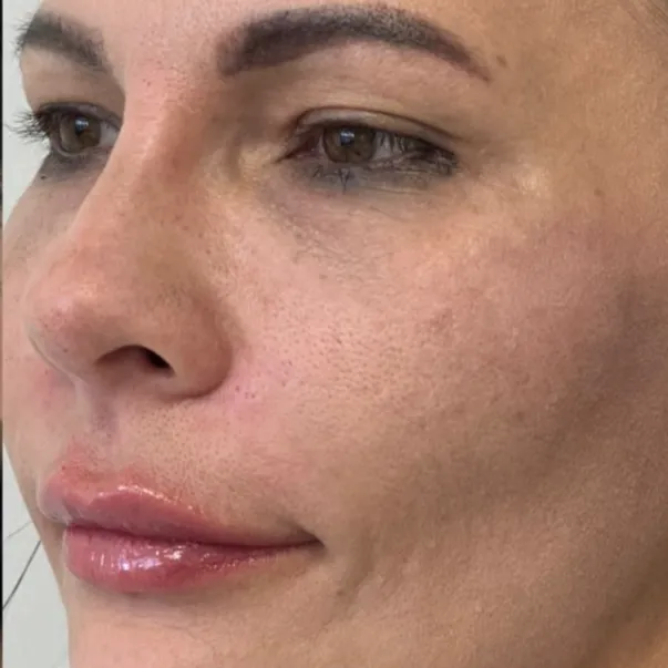 luciana-tchaick-harmonizacao-orofacial-caxias-do-sul-antes-e-depois